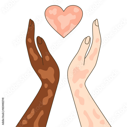 Set hand vitiligo people with love. Unique skin pigmentation highlighting natural beauty. World vitiligo day. Skin depigmentation, skin disorder, self acceptance, emotional support.