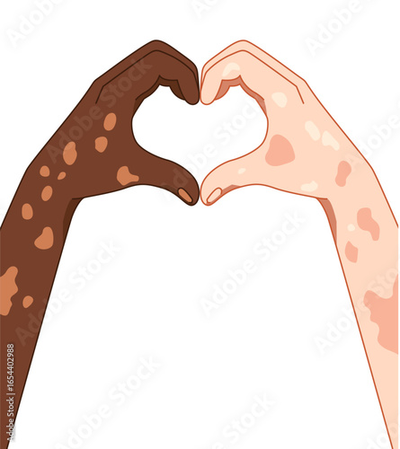 Vitiligo people create love gesture. Unique skin pigmentation highlighting natural beauty. World vitiligo day. Skin depigmentation, skin disorder, self acceptance, emotional support.