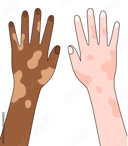 Set hand of people with vitiligo. Unique skin pigmentation highlighting natural beauty and self expression. World vitiligo day. Skin depigmentation, skin disorder, self acceptance.