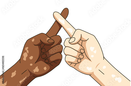 Set hand of people with vitiligo. Unique skin pigmentation highlighting natural beauty and self expression. World vitiligo day. Skin depigmentation, skin disorder, self acceptance.