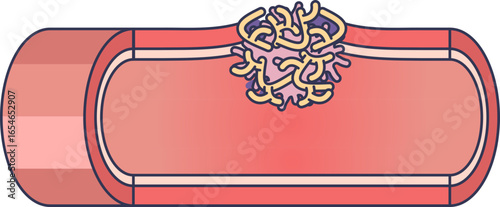 An illustration of a blood clot forming on an injured blood vessel wall. This depicts the natural process of hemostasis, which is fundamental to controlling bleeding and wound healing.