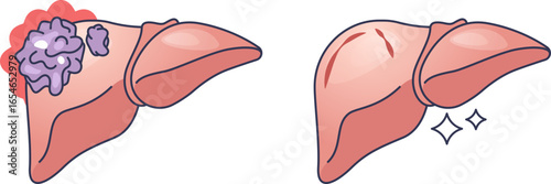An illustration comparing a liver with a cancerous tumor to a healthy, healed liver. This before-and-after visual symbolizes liver cancer remission, recovery, and successful treatment.
