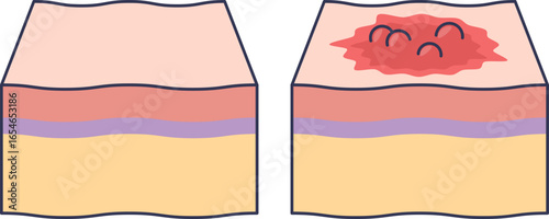 A medical illustration comparing healthy skin layers to skin with contact dermatitis, showing inflammation, redness, and rash on the epidermis as a result of an allergic reaction.