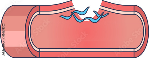A medical illustration of a damaged blood vessel with exposed collagen fibers. This depicts vascular injury, which triggers platelet adhesion and initiates the coagulation cascade for hemostasis.
