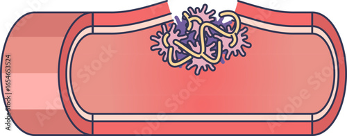 Diagram of a fibrin mesh and platelets sealing a ruptured blood vessel. This visualizes the coagulation cascade, forming a clot to stop bleeding and begin tissue repair.