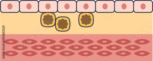 Diagram of a fatty streak lesion, an early stage of atherosclerosis. Shows foam cells (lipid-laden macrophages) accumulating under the endothelium in an artery wall.