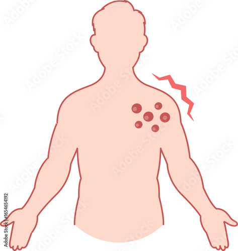 An illustration of a person with a painful skin rash and blisters on their chest, representing a severe idiosyncratic reaction or adverse drug event.