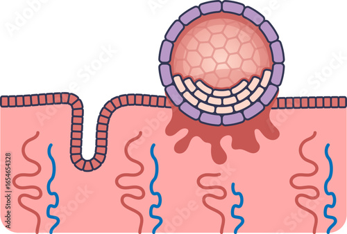 A medical illustration of a blastocyst implanting into the endometrium. This diagram shows the embryo attaching to the uterine wall, a key stage of early pregnancy and human reproduction.