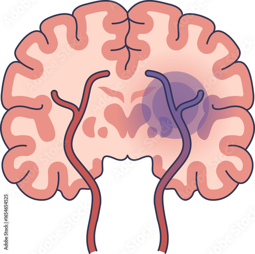 Medical illustration of an ischemic stroke. A blocked blood vessel in the brain causes tissue damage (infarction) due to lack of blood flow and oxygen. Main objects: brain, artery, blood clot.
