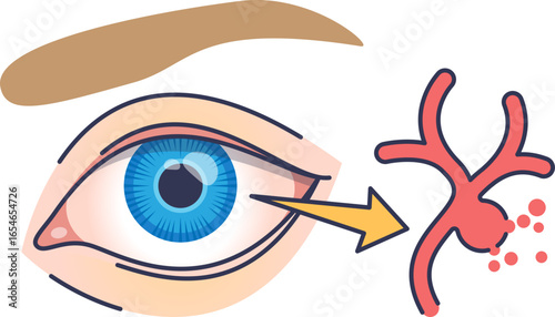 Medical illustration of a leaky retinal vessel. An eye points to a damaged blood vessel leaking fluid, symbolizing conditions like diabetic retinopathy or macular edema.