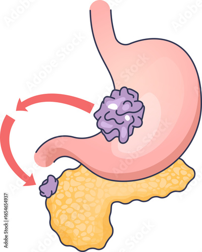 An illustration showing a metastatic colony. Cancer cells from a primary tumor in the stomach spread to the pancreas, forming a secondary tumor, depicting the process of cancer metastasis.