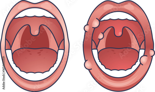 A medical illustration comparing a healthy mouth to one with Oral Allergy Syndrome. The affected mouth shows symptoms like swelling, blisters, and redness on the lips and oral mucosa.