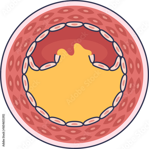 Medical illustration of a ruptured atherosclerotic plaque in an artery. This unstable plaque event can lead to thrombosis, causing a heart attack or stroke.