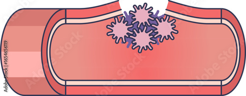A medical illustration of platelet plug formation. Activated platelets (thrombocytes) are shown aggregating at the site of an injury in a blood vessel wall to initiate hemostasis.