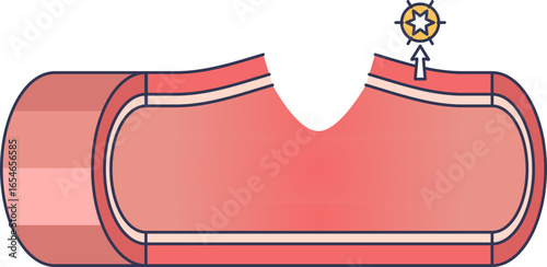Medical illustration of a damaged blood vessel wall. The injury exposes Tissue Factor, initiating the extrinsic pathway of the blood coagulation cascade.
