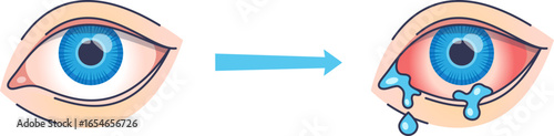 An illustration showing the progression from a healthy eye to a red, irritated eye with excessive tearing, representing watery eye symptoms, allergies, or conjunctivitis.