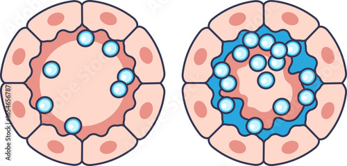 Medical illustration comparing normal and excessive airway mucus secretion. The right side shows hypersecretion from epithelial cells, leading to mucus buildup and airway obstruction.