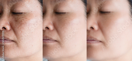 cropped Image before and after spot melasma pigmentation treatment on skin face asian woman compare in 3 development periods. Skincare and beauty concept.
