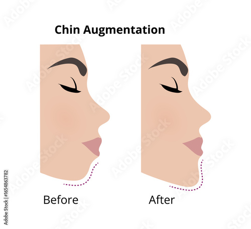 Woman face profile undergoing chin augmentation surgery