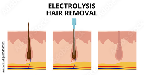 Electrolysis hair removal process showing probe inserting into hair follicle