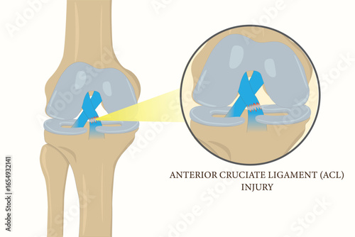 Medical illustration of anterior cruciate ligament (ACL) tear showing knee joint injury detail. eps 10