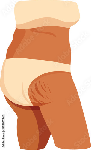 Female body with stretch marks, demonstrating a common skin condition