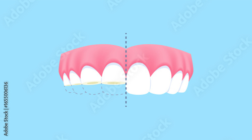 Upper teeth - Attrition (Before and After Comparison) illustration vector design. Dental care concept.