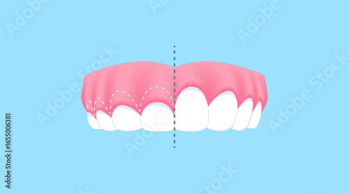 Upper teeth - Gummy Smile (Before and After Comparison) illustration vector design. Dental care concept.