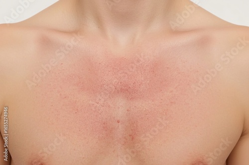 Wallpaper Mural Close-up of reddened chest skin Torontodigital.ca