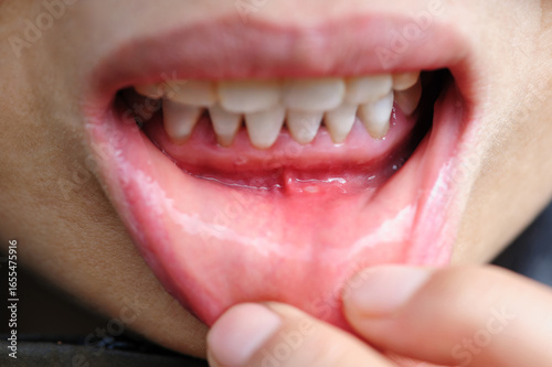 Showing mouth ulcer or canker sore or aphthous stomatitis or aphthous ulcer