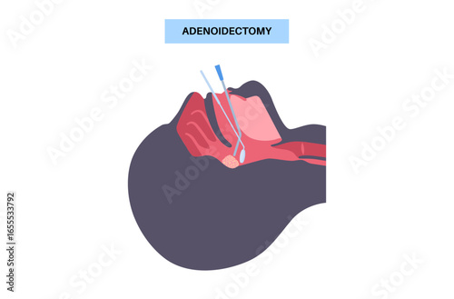 Adenoidectomy medical procedure