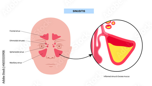 Sinusitis medical poster