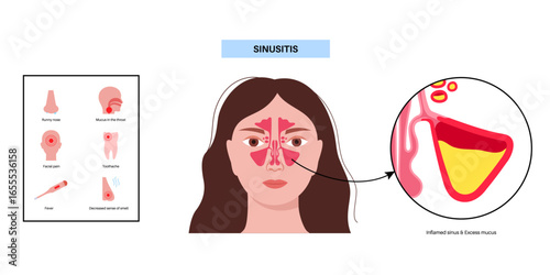 Sinusitis medical poster