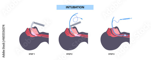 Intubation medical procedure