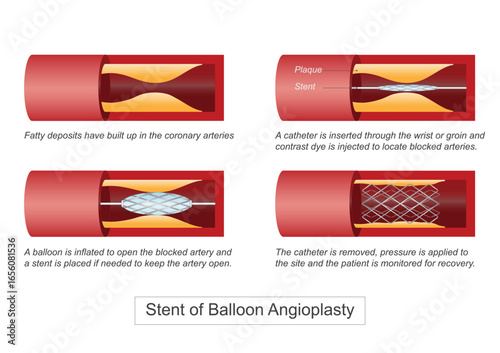 Balloon angioplasty is a minimally invasive procedure to widen narrowed or blocked arteries