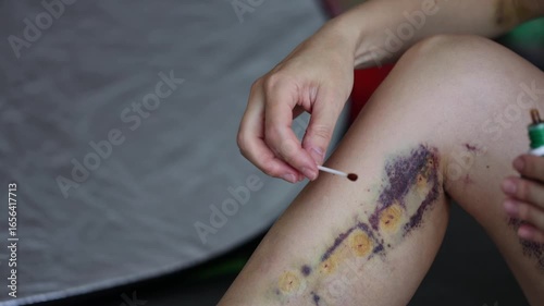 Post operative wound treatment. Close-up shot of patient legs. 4K