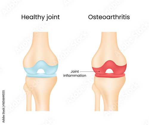 Hip Joint Healthy and Hip Joint Osteoarthritis Disease