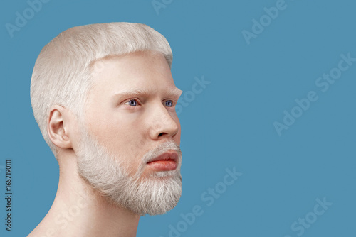 Obraz na plátne Albinism concept