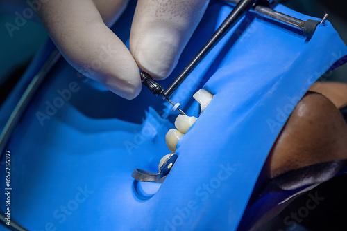 Cuadro en lienzo Dentist’s hands inserting a dental file into a tooth during root canal treatment with rubber dam isolation