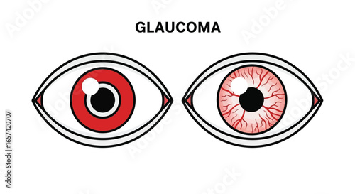 Glaucoma Eye Condition - Medical Illustration