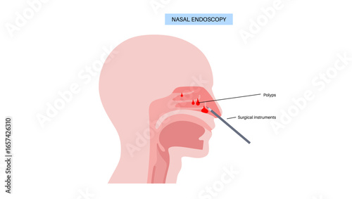 Nasal endoscopy poster