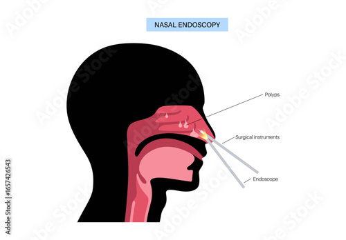 Nasal endoscopy poster