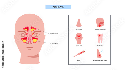 Sinusitis medical poster