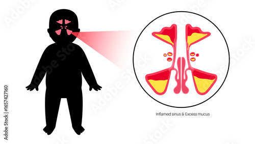Sinusitis medical poster