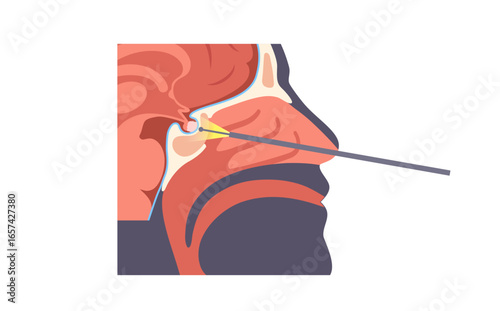 Pituitary gland surgery