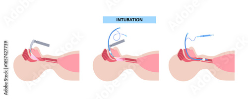 Intubation medical procedure