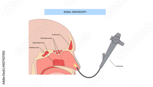 Nasal endoscopy poster