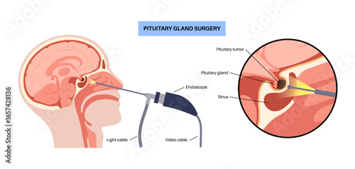 Pituitary gland surgery