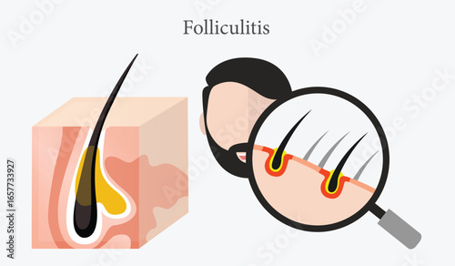 Folliculitis inflamed skin, folliculitis illustration.