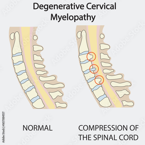 Degenerative cervical myelopathy vector: shows spinal cord compression with symptoms like neck pain, numbness, weakness, balance issues; similar diseases include MS, ALS, cervical radiculopathy. icon